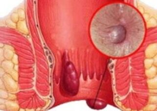 What do hemorrhoids look like