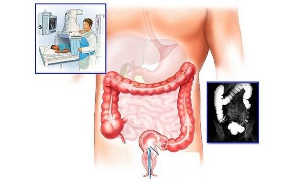 Contrast-enhanced colon X-ray for the diagnosis of hemorrhoids